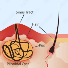 Pilonidal sinus